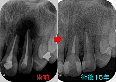 間違った根管治療で大きな根尖病変（膿） - EE DENTAL_Blog